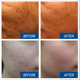 acne scars and pore minimizing